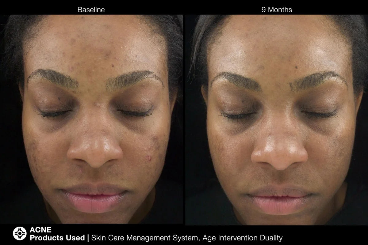 Age Intervention® Duality™