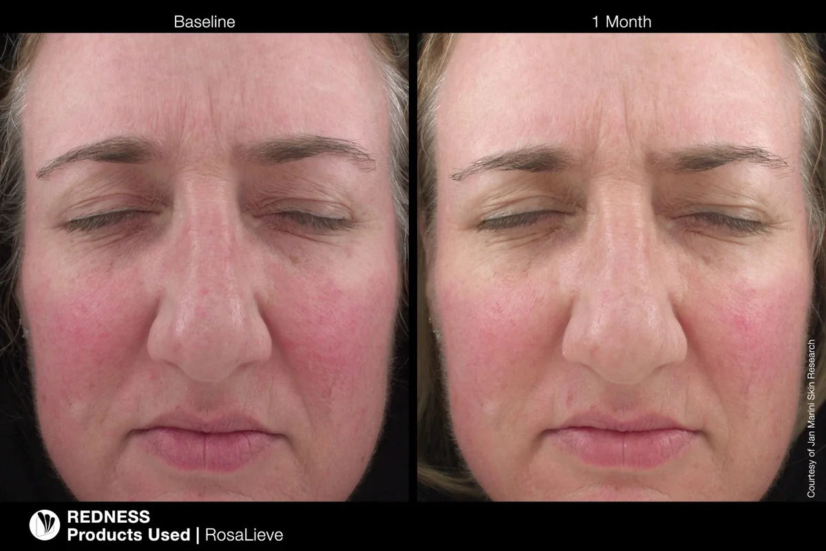 RosaLieve® Redness Reducer